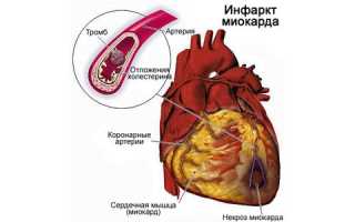 Протезирования аортального клапана реабилитация после