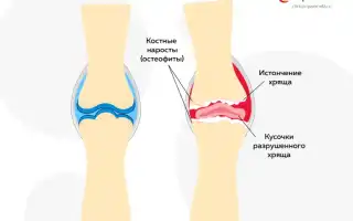 Почему хрустят колени и можно ли это исправить: советы и рекомендации