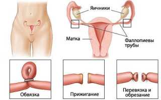 Плюсы и минусы процедуры перевязки фаллопиевых труб