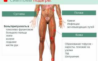 Подагра у мужчин: признаки, причины и лечение заболевания
