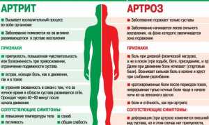 Почему артрит не перепутаешь с артрозом, причины появления этих заболеваний и их отличия