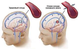 Сужение сосудов головного мозга, кому грозит и как распознать проблему