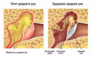 Экссудативный отит у детей — коварное заболевание среднего уха