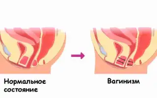 Причины и лечение вагинизма у женщин: важные аспекты и советы