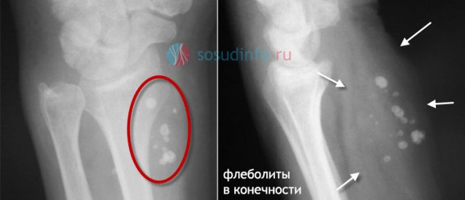 Флеболиты в малом тазу что это такое