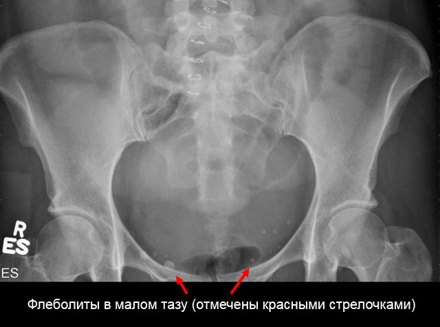 Как избавиться от флеболитов в малом тазу