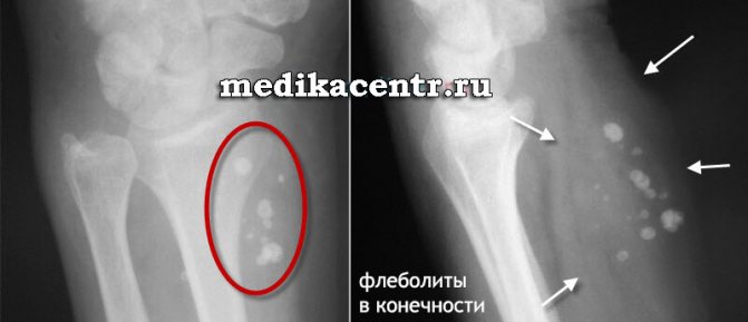 Признаки флеболитов