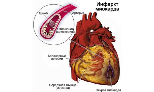 Протезирования аортального клапана реабилитация после