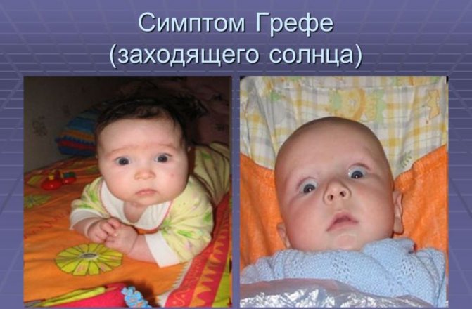 Симптом Грефе