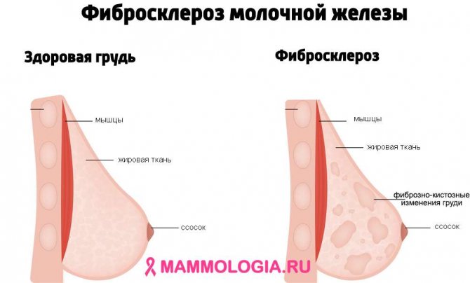 Так выглядит фибросклероз молочной железы