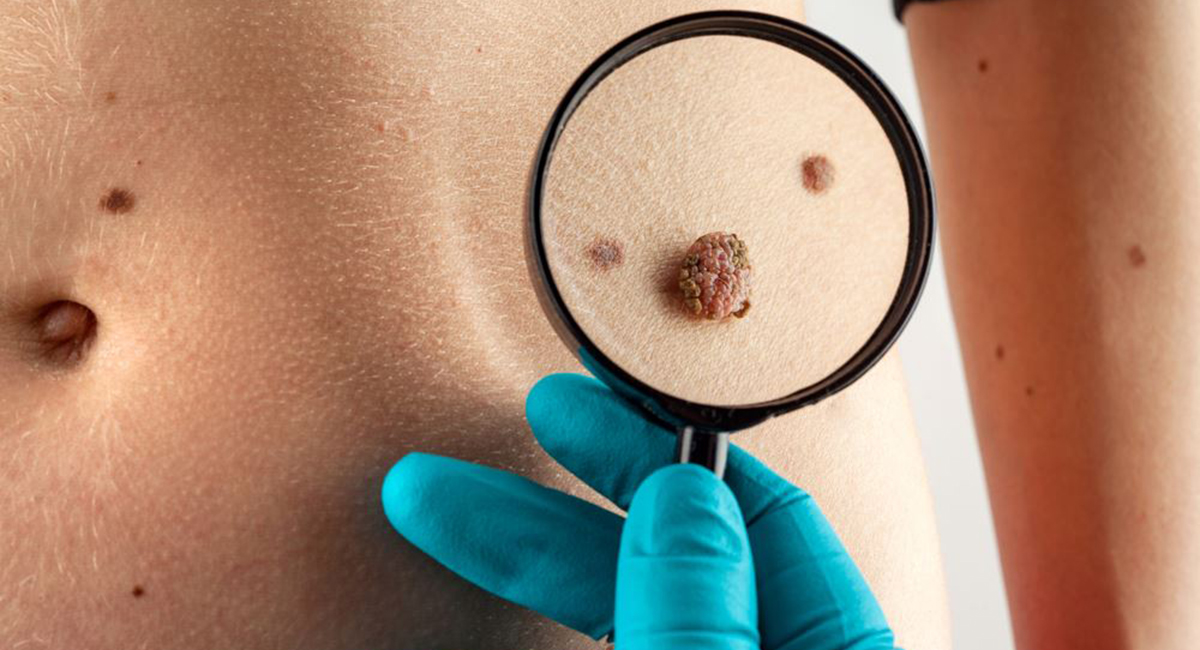 Что означают родинки Что означают родинки