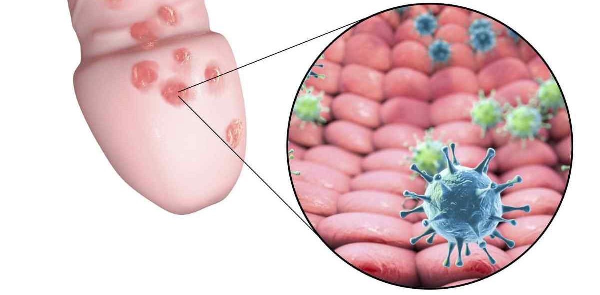Генитальный герпес Генитальный герпес