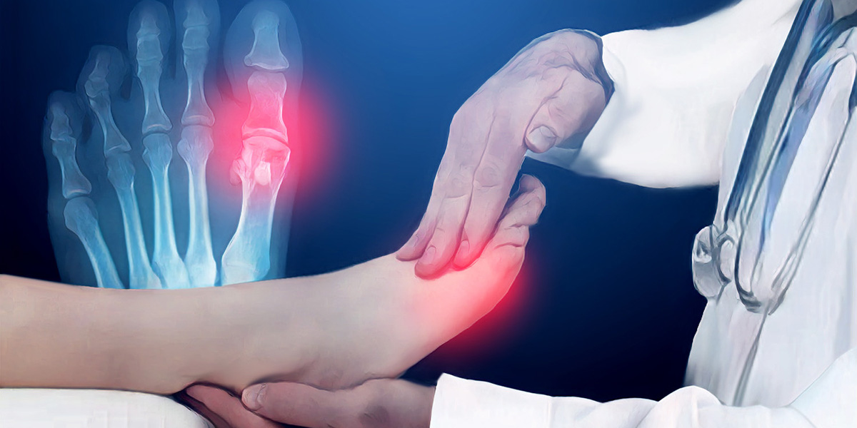 Подагру называли королевской болезнью, панской хворобой, болезнью аристократов, даже считали признаком гениальности и сумасшествия. Рассмотрим что такое подагра и методы лечения. Подагру называли королевской болезнью, панской хворобой, болезнью аристократов, даже считали признаком гениальности и сумасшествия. Рассмотрим что такое подагра и методы лечения.