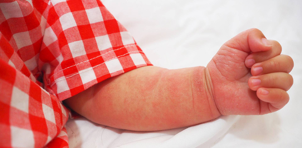 Если крапивница проявилась в виде покраснения и невскрывающихся пузырьков, то лучше всего обработать кожу детской присыпкой — она успокоит зуд, снимет раздражение, а тальк, входящий в состав любой присыпки, ускорит процесс заживления. Если крапивница проявилась в виде покраснения и невскрывающихся пузырьков, то лучше всего обработать кожу детской присыпкой — она успокоит зуд, снимет раздражение, а тальк, входящий в состав любой присыпки, ускорит процесс заживления.