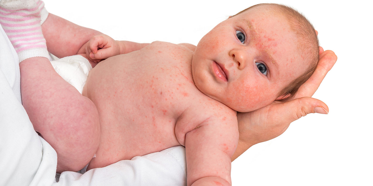 Для детской формы заболевания (2-12 лет) характерны кожная сыпь на сгибательных поверхностях рук и ног, высыпания на шее, гиперемия и отек кожи, утолщение и усиление кожного рисунка, папулы, бляшки, эрозии, трещины, расчесы и корочки. Для детской формы заболевания (2-12 лет) характерны кожная сыпь на сгибательных поверхностях рук и ног, высыпания на шее, гиперемия и отек кожи, утолщение и усиление кожного рисунка, папулы, бляшки, эрозии, трещины, расчесы и корочки.