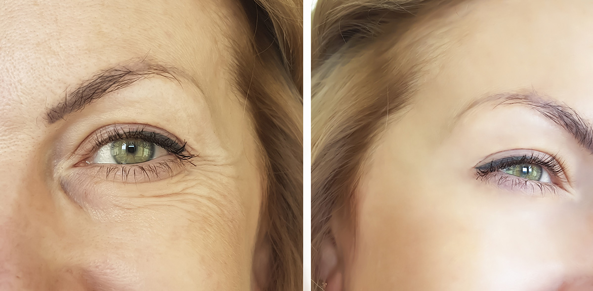 блефаропластика блефаропластика