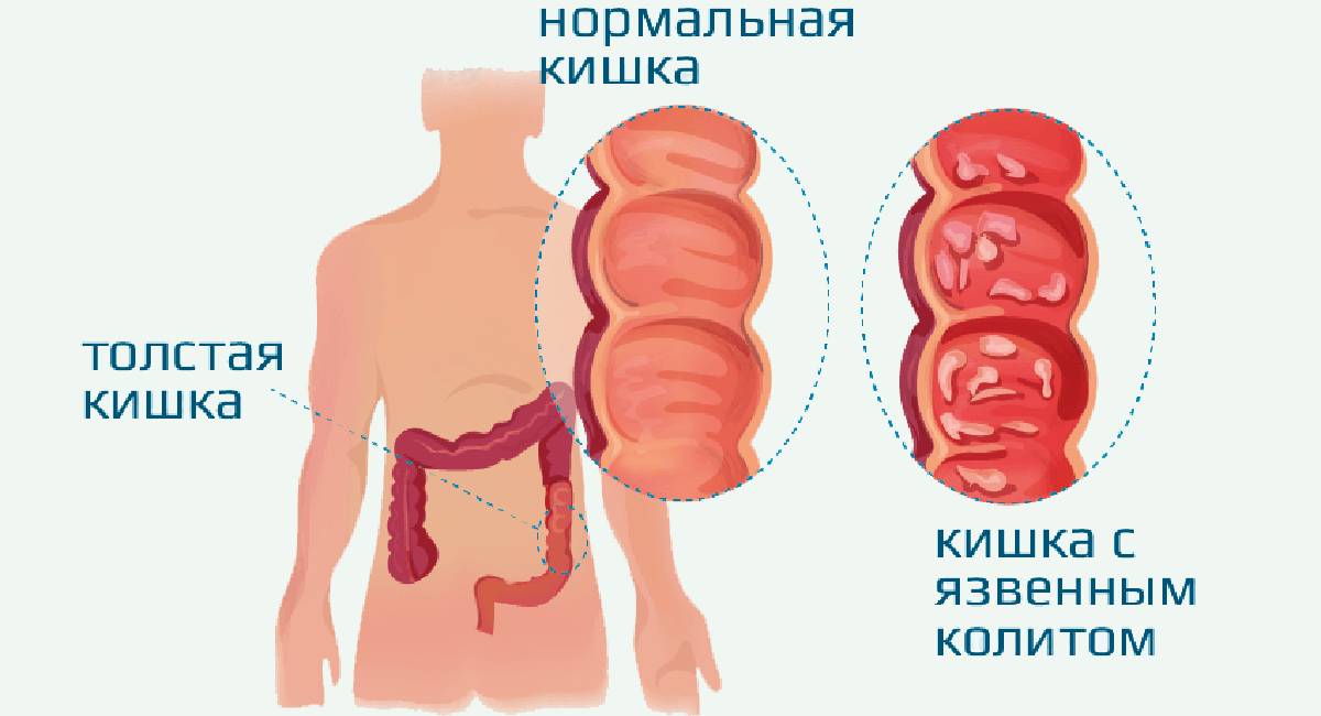 Неспецифический язвенный колит лечение Неспецифический язвенный колит лечение