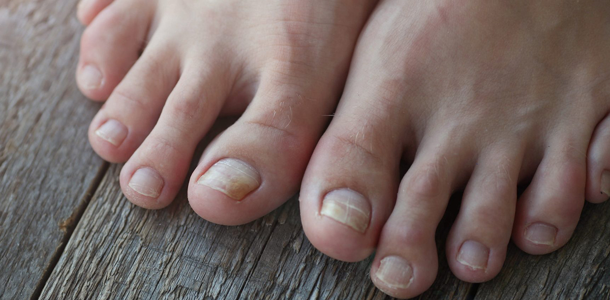 Грибок ногтей и стопы. Вид Грибок ногтей и стопы. Вид