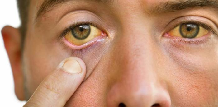 Гепатит или желтуха Гепатит или желтуха