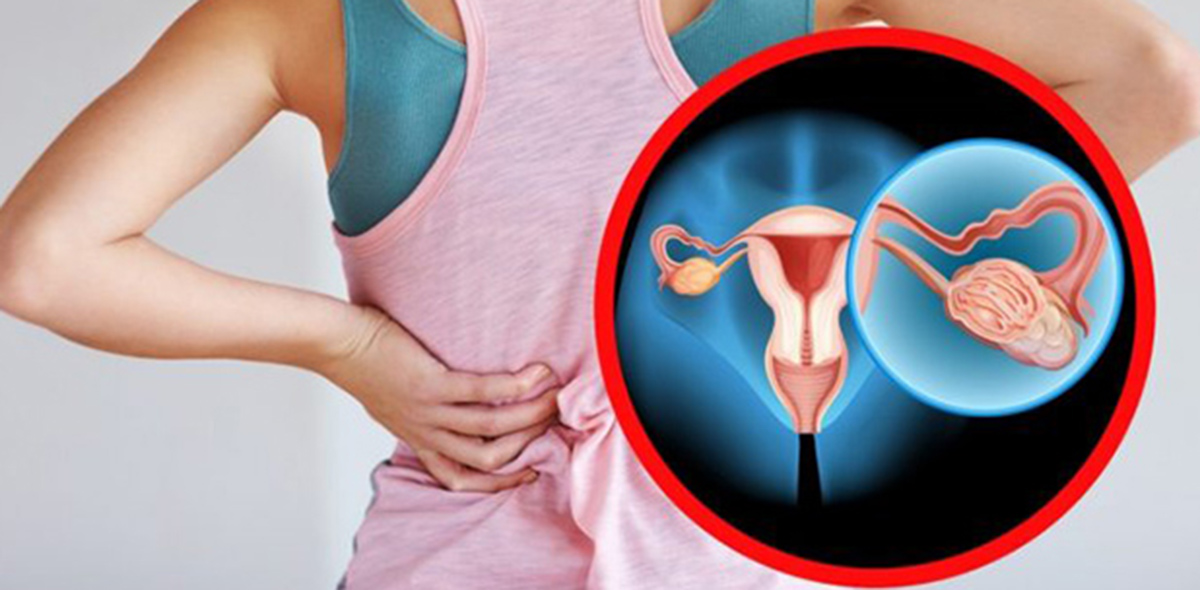 Рак яичников Рак яичников