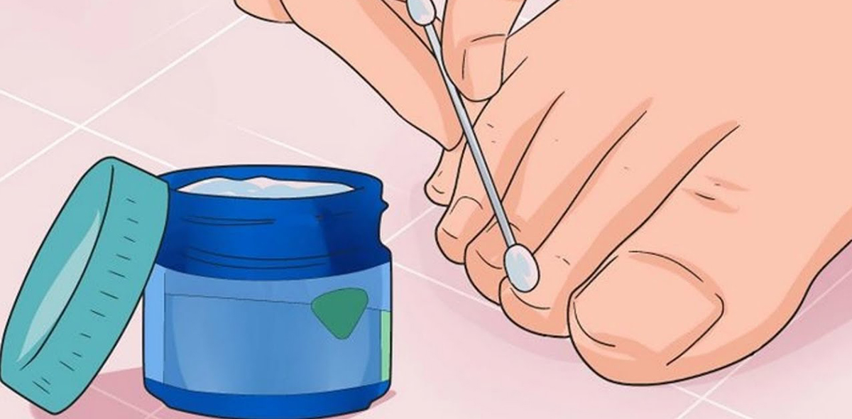 Грибок ногтей и стопы. Болезнь Грибок ногтей и стопы. Болезнь