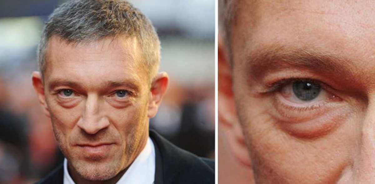 Мешки под глазами Мешки под глазами