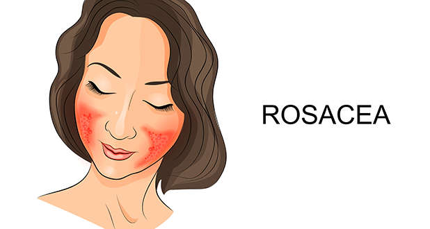 Купероз Купероз