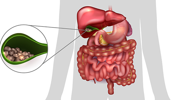 Желчнокаменная болезнь Желчнокаменная болезнь